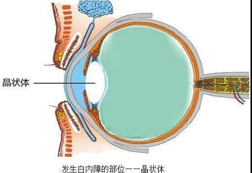 白内障4.jpg