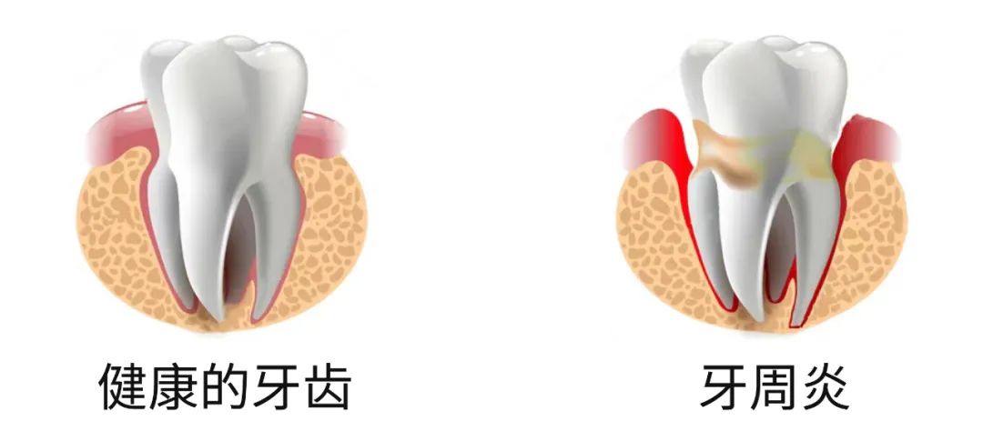 牙周6.jpg